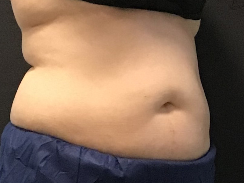 CoolSculpting Before & After Image