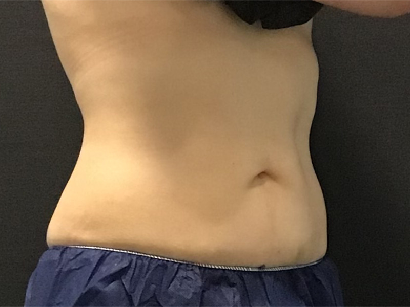 CoolSculpting Before & After Image