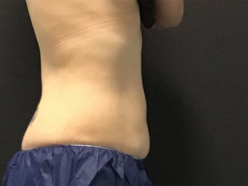 CoolSculpting Before & After Image