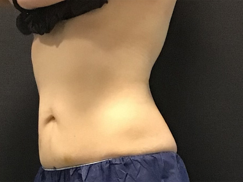 CoolSculpting Before & After Image