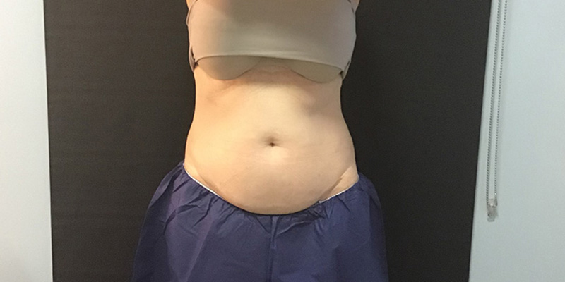 CoolSculpting Before & After Image