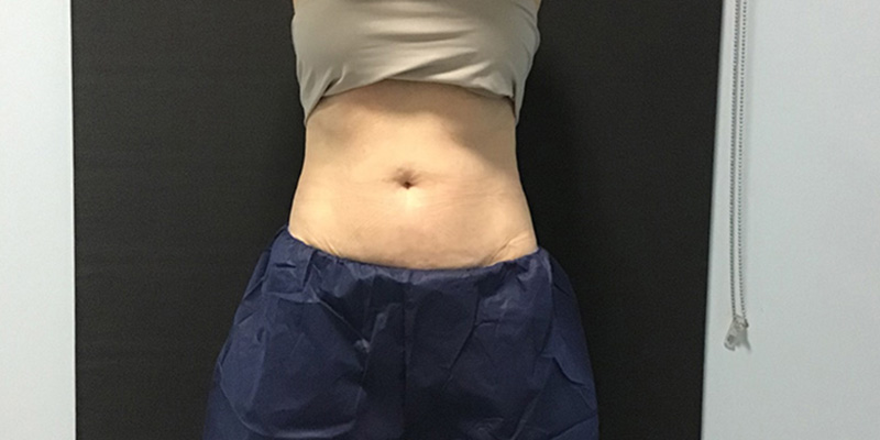 CoolSculpting Before & After Image