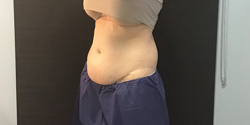 CoolSculpting Before & After Image