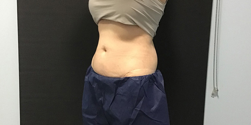CoolSculpting Before & After Image