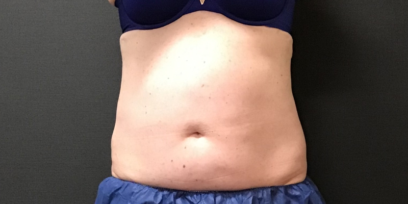 CoolSculpting Before & After Image