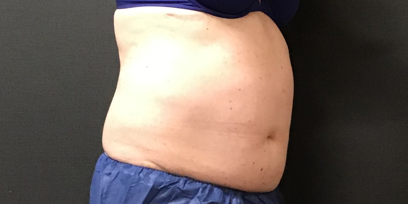 CoolSculpting Before & After Image