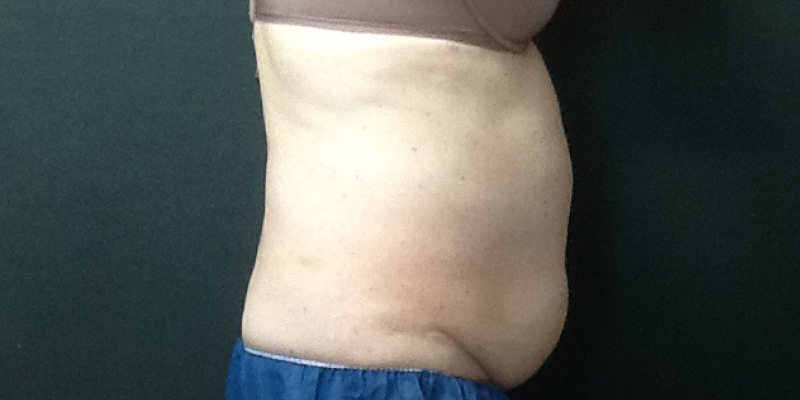 CoolSculpting Before & After Image