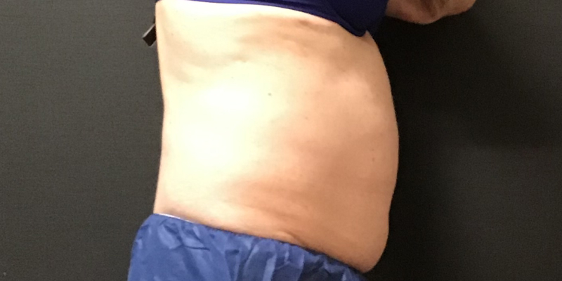 CoolSculpting Before & After Image