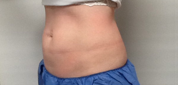 CoolSculpting Before & After Image