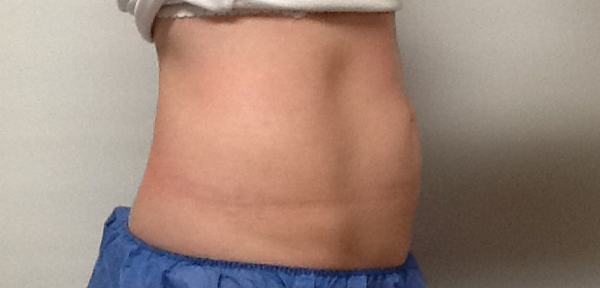 CoolSculpting Before & After Image