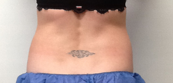 CoolSculpting Before & After Image