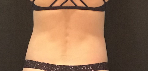 CoolSculpting Before & After Image