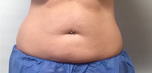 CoolSculpting Before & After Image