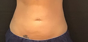 CoolSculpting Before & After Image