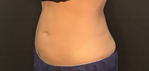 CoolSculpting Before & After Image