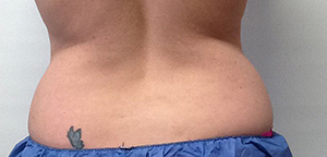 CoolSculpting Before & After Image