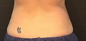 CoolSculpting Before & After Image