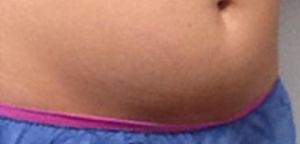 CoolSculpting Before & After Image