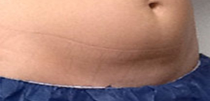 CoolSculpting Before & After Image