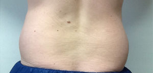 CoolSculpting Before & After Image