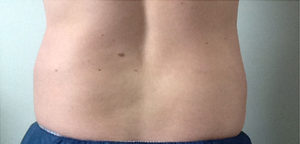 CoolSculpting Before & After Image