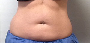 CoolSculpting Before & After Image