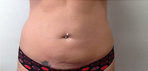 CoolSculpting Before & After Image