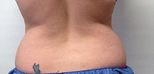 CoolSculpting Before & After Image