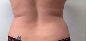 CoolSculpting Before & After Image