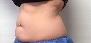 CoolSculpting Before & After Image