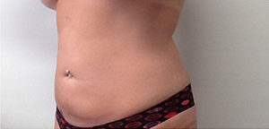 CoolSculpting Before & After Image