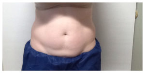 CoolSculpting Before & After Image