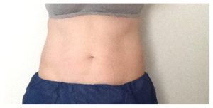 CoolSculpting Before & After Image