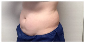 CoolSculpting Before & After Image