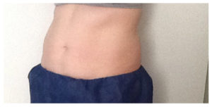 CoolSculpting Before & After Image