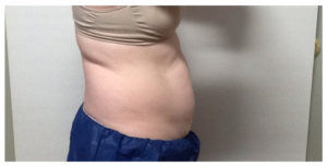 CoolSculpting Before & After Image