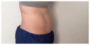 CoolSculpting Before & After Image