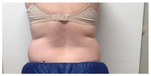 CoolSculpting Before & After Image