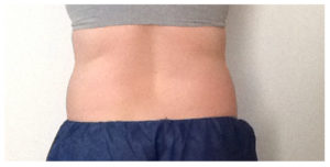 CoolSculpting Before & After Image