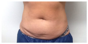 CoolSculpting Before & After Image