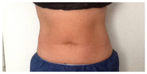 CoolSculpting Before & After Image