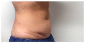 CoolSculpting Before & After Image