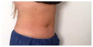 CoolSculpting Before & After Image