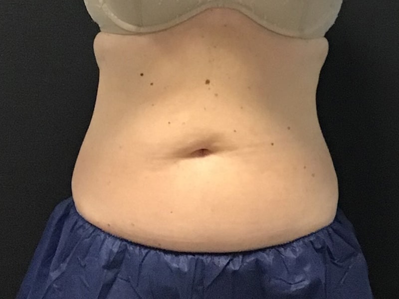 CoolSculpting Before & After Image