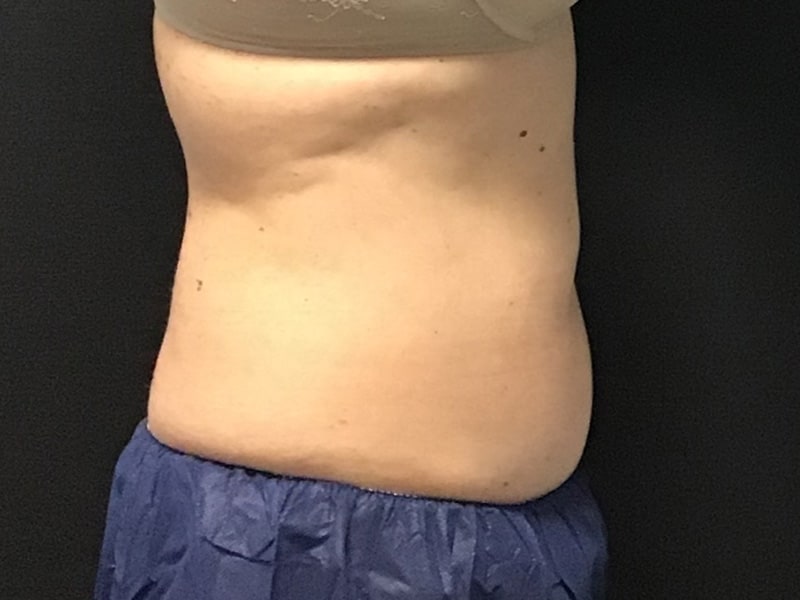 CoolSculpting Before & After Image