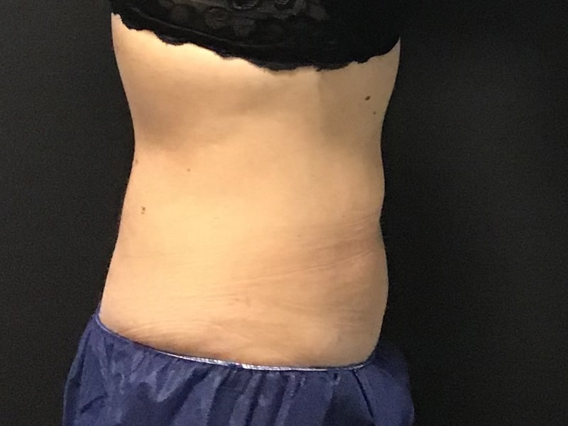 CoolSculpting Before & After Image