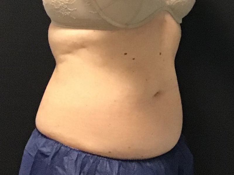 CoolSculpting Before & After Image