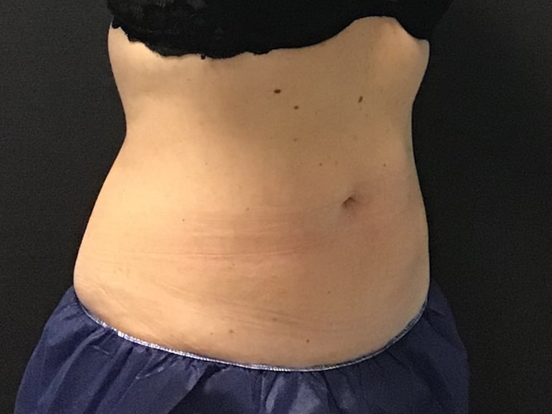 CoolSculpting Before & After Image