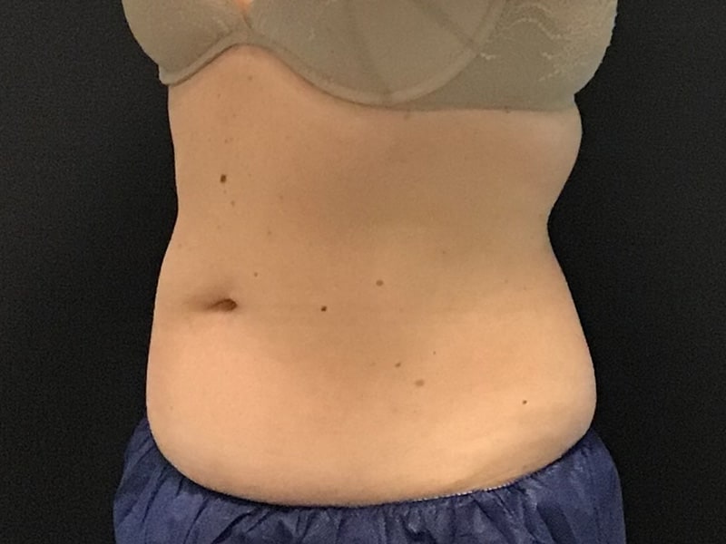 CoolSculpting Before & After Image