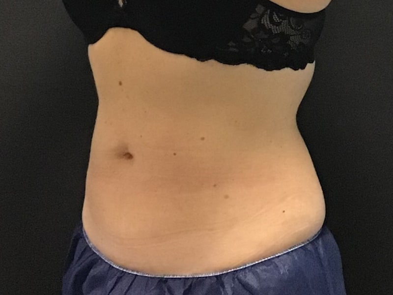 CoolSculpting Before & After Image